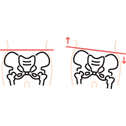 正常な骨盤と歪んだ骨盤